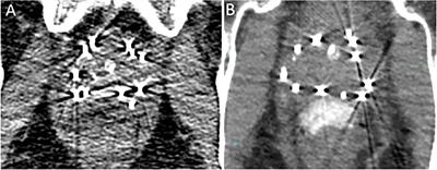 Case Report: Role of an Iodinated Rectal Hydrogel Spacer, SpaceOAR Vue™, in the Context of Low-Dose-Rate Prostate Brachytherapy, for Enhanced Post-Operative Contouring to Aid in Accurate Implant Evaluation and Dosimetry